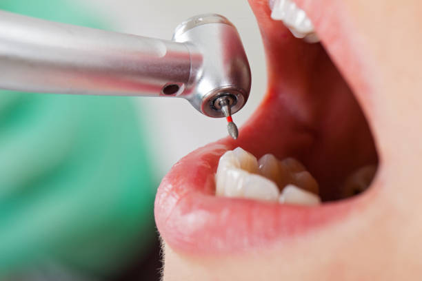 Best Emergency Tooth Extraction in Coffeyville, KS